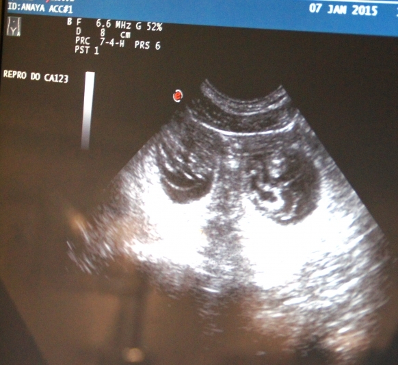 Billede af Anayas første drægtighedsscanning den 7. januar 2015